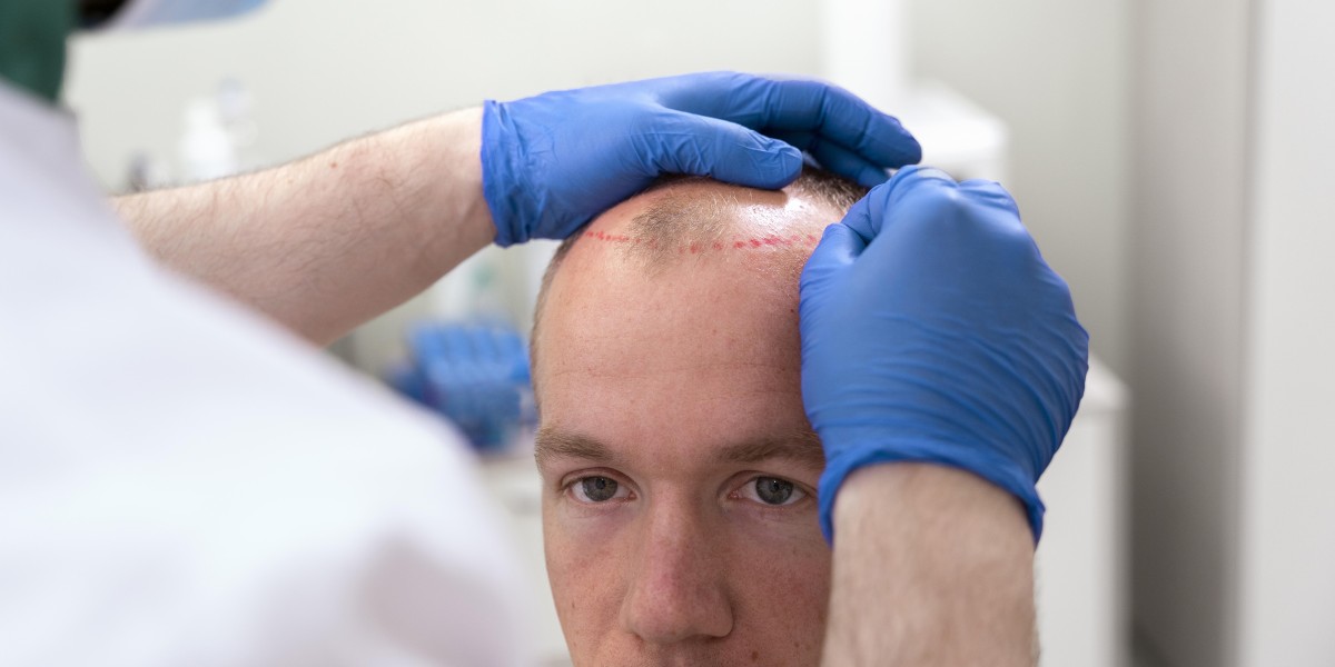 Optimize forehead reduction los angeles Recovery Tips