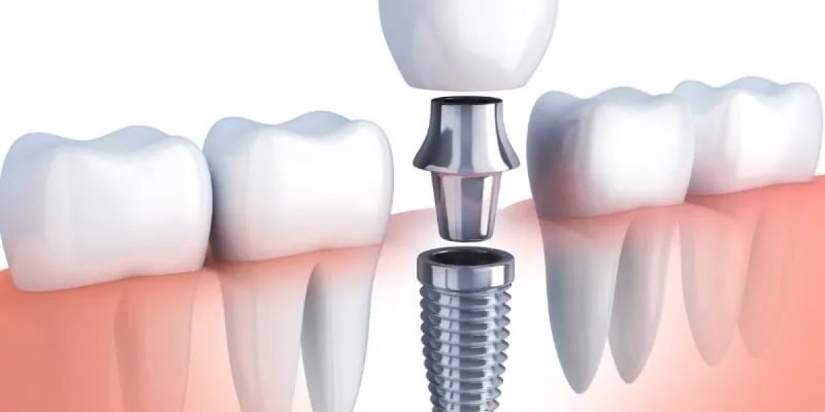 Advanced Composite Fillings Services in McKinney, TX: Restoring Teeth with Aesthetic Precision