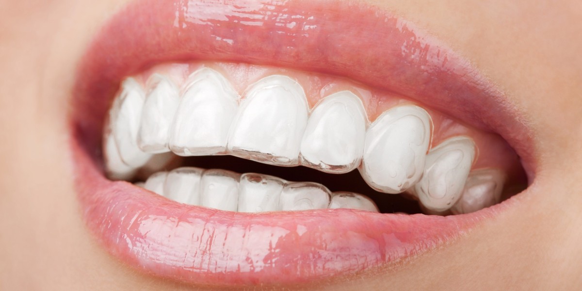 Common Myths About Invisalign Treatment Debunked (Amma Naana Dental Clinic)