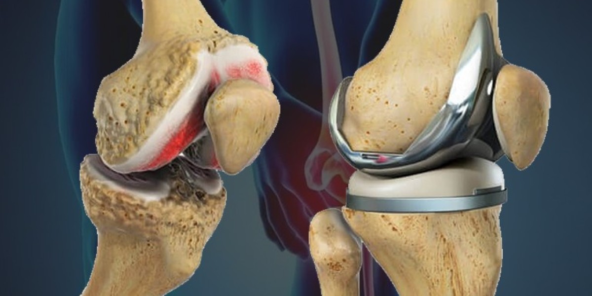 Finding the Right Surgeon for Your Knee Replacement in Delhi