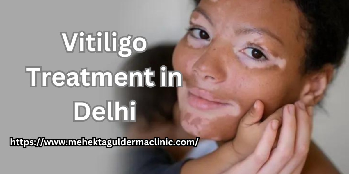 Everything One Needs To Know About Vitiligo