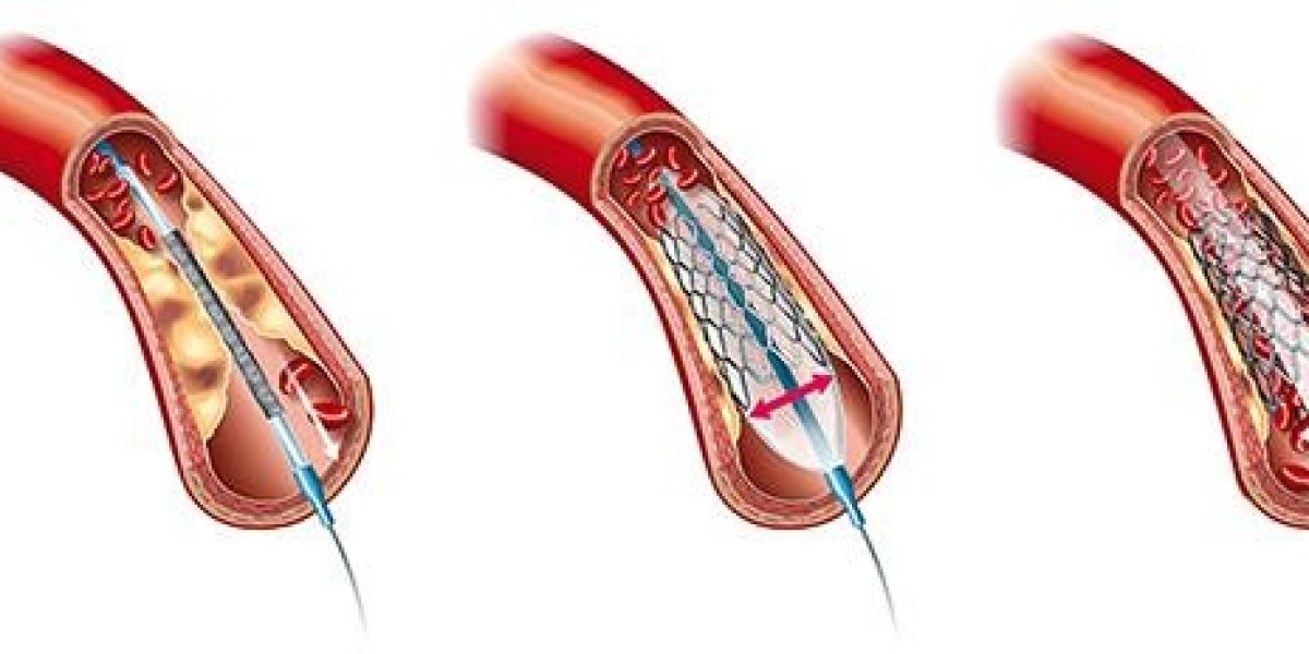 Peripheral Angioplasty in Jaipur: Restoring Blood Flow